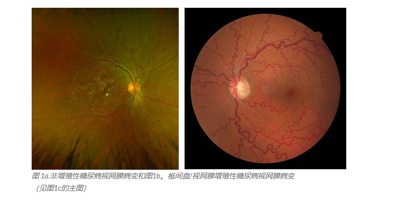 营养与糖尿病视网膜病变：改变视力的途径